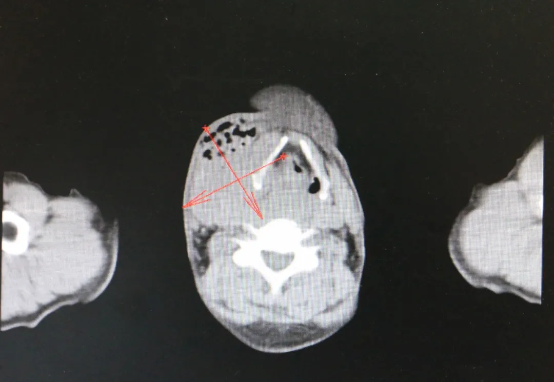下咽癌患者赠红包深情感谢,微创介入治疗延长生命长度