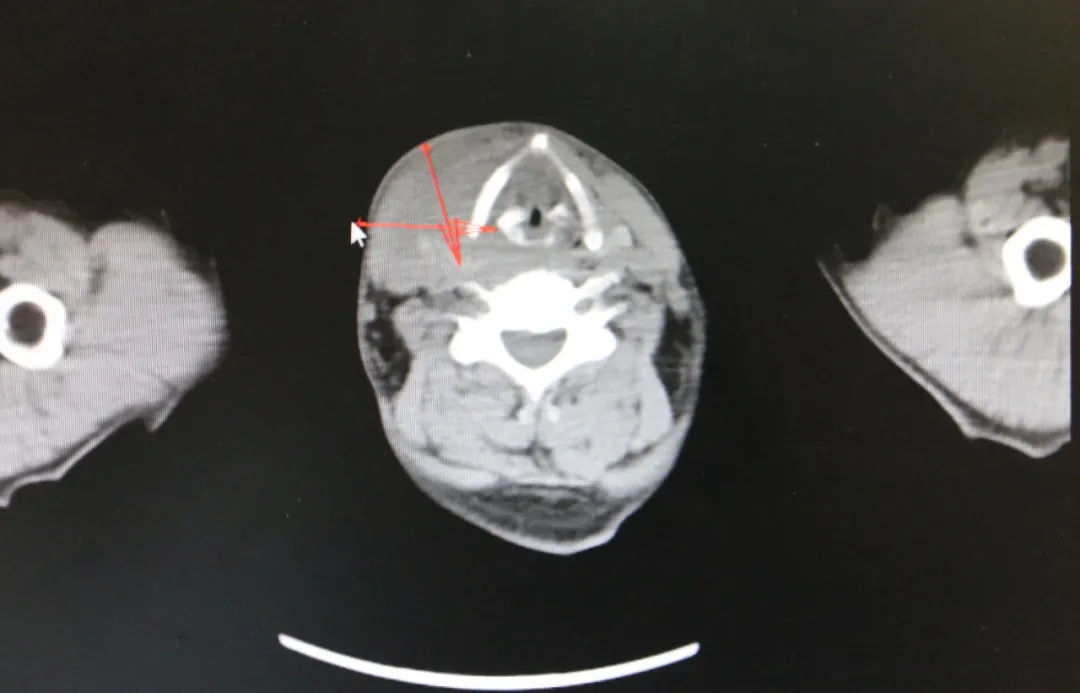 下咽癌患者赠红包深情感谢,微创介入治疗延长生命长度